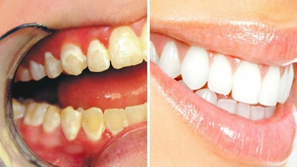 Эффективные способы борьбы с зубным налетом