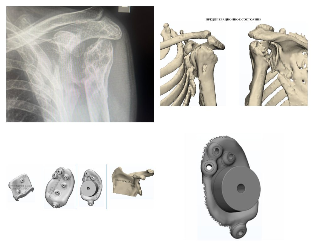 В Кургане участнику СВО из ЛНР вернули подвижность руки с помощью уникального импланта