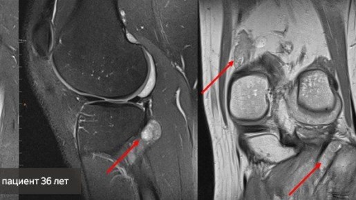В Центре Илизарова во время плановых обследований пациентов диагностировали две необычные патологии опорно-двигательного аппарата